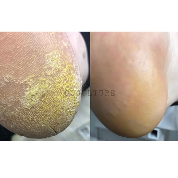 Callus Remover Pedicure Dead skin heels toe - Picture 3 of 4